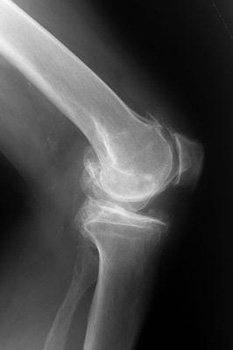 Radiografía de rodilla