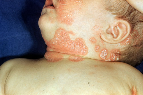 Psoriasis