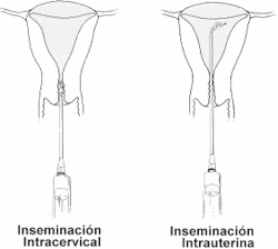 Inseminación artificial