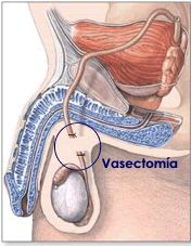 Vasectomía